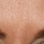 Patient's brow after Botox