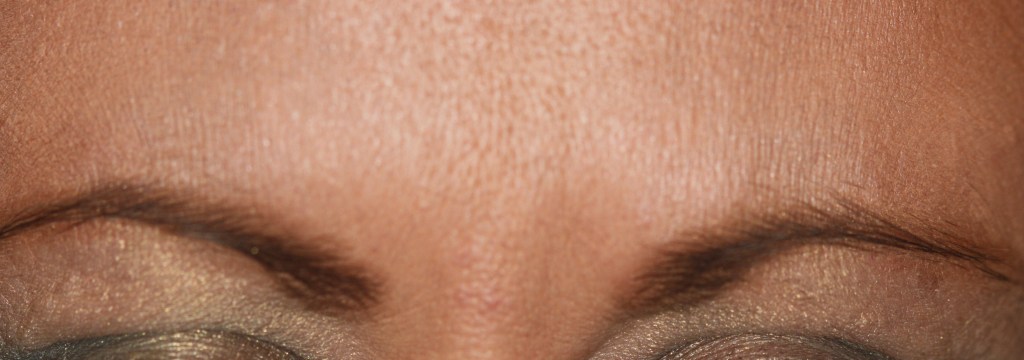 Patient's brow after Botox