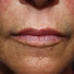 Patient's lips after Juvederm