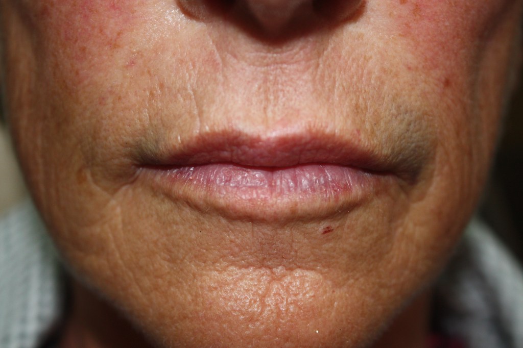 Patient's lips after Juvederm