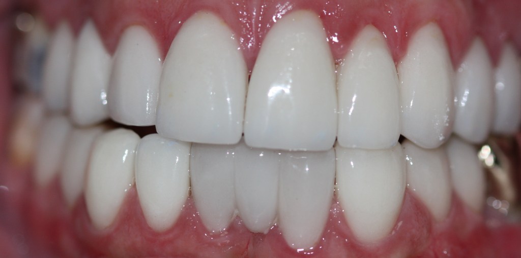 Patient's teeth after veneers and a bridge