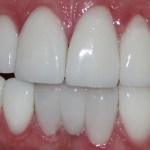 Patient's teeth after veneers and a bridge