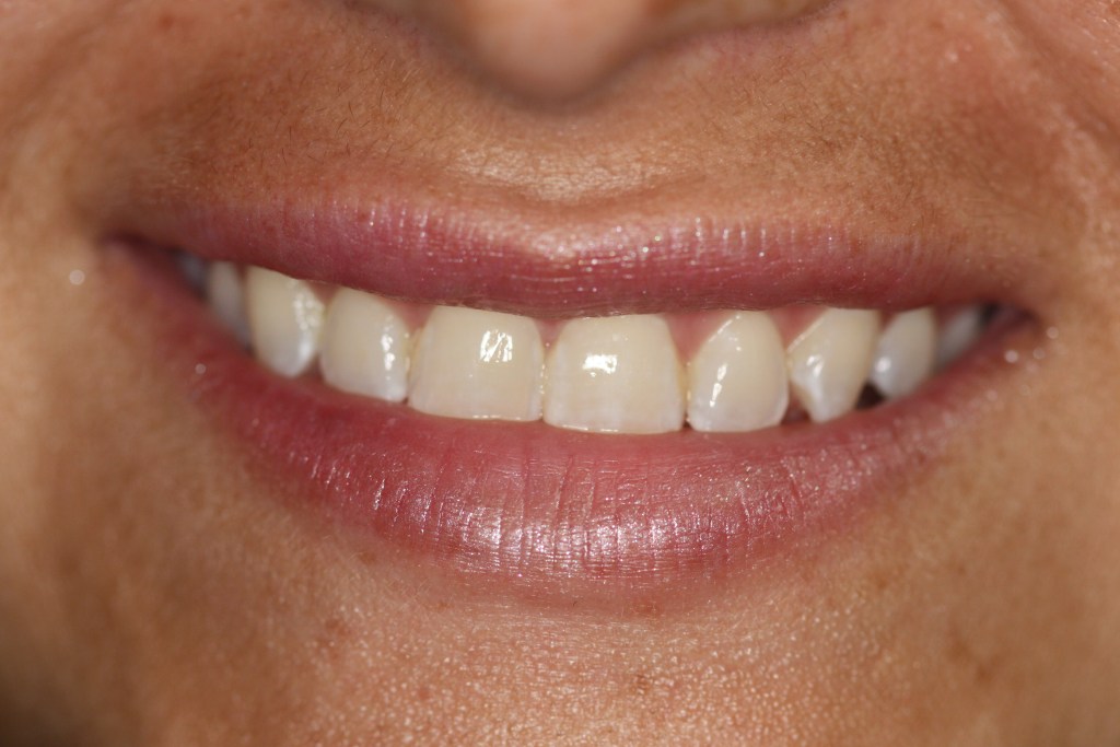 Patient's lips after Juvederm