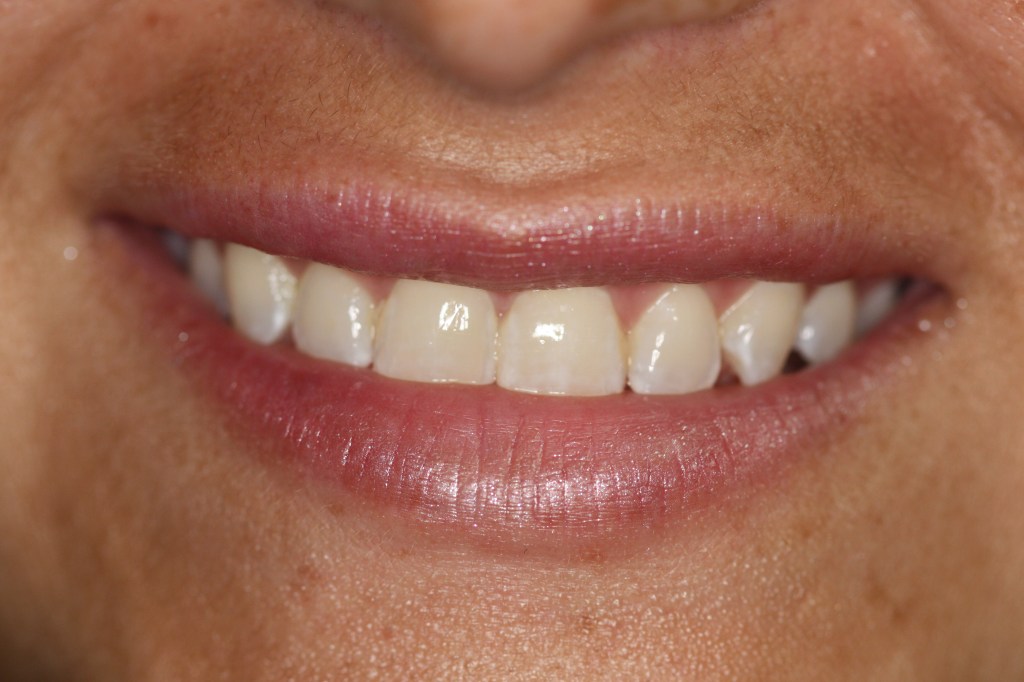 Patient's lips after Juvederm