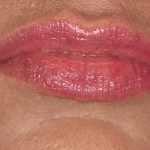Patient's lips after Juvederm