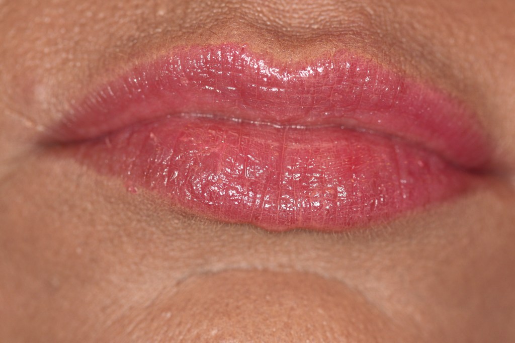 Patient's lips after Juvederm