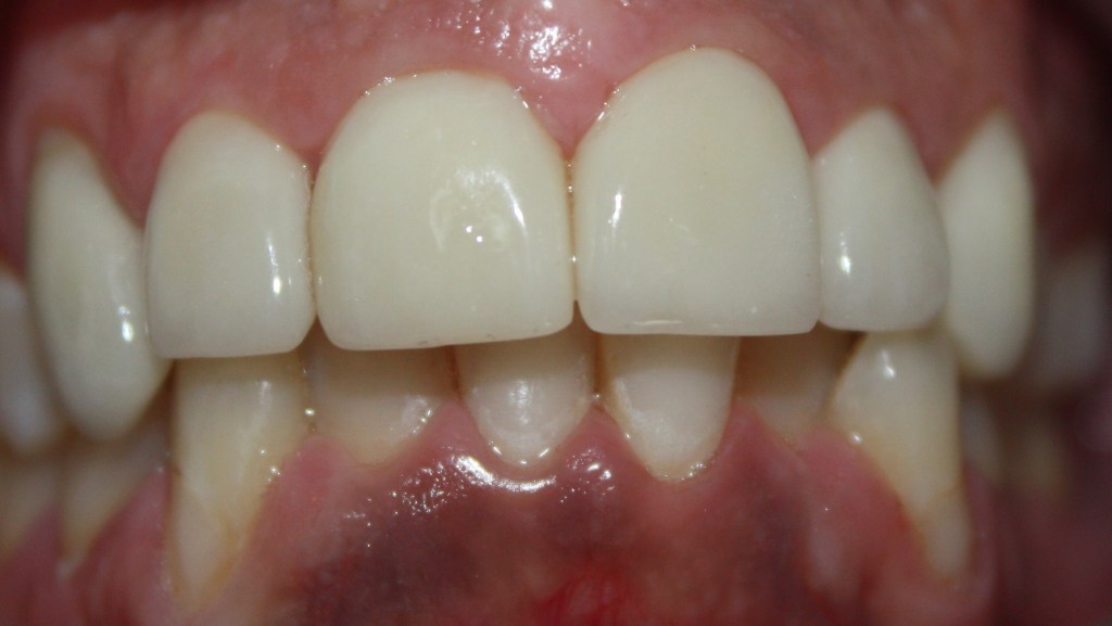 Patient's teeth after Veneers