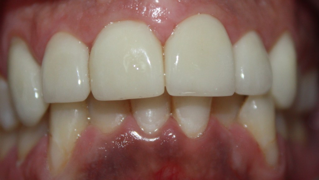 Patient's teeth after Veneers