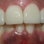 Patient's teeth after Veneers