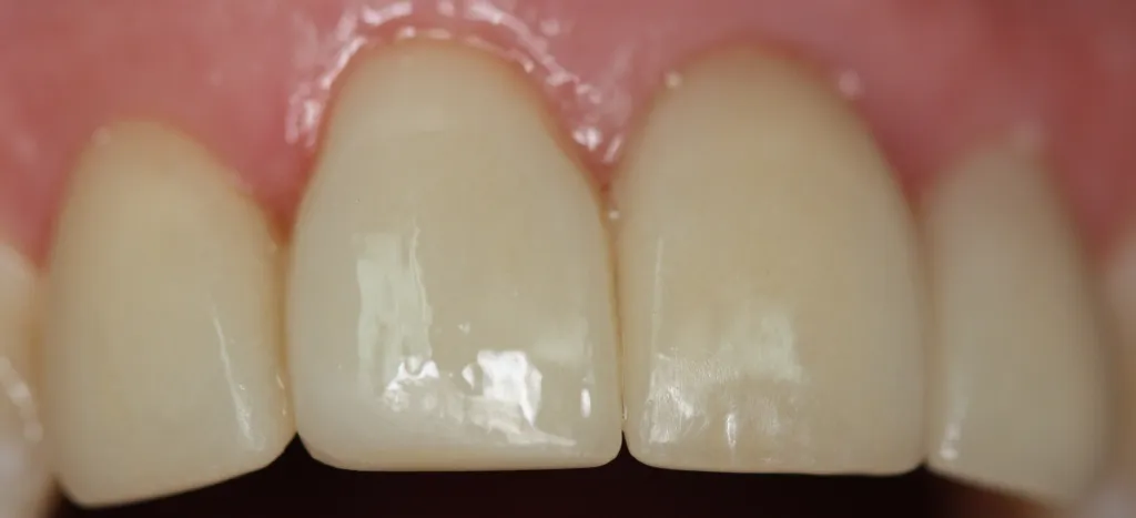Patient's teeth after Veneers