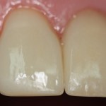Patient's teeth after Veneers