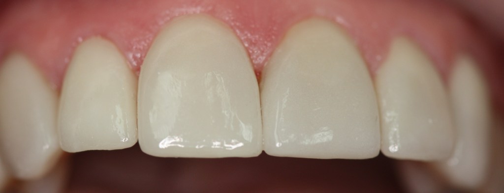 Patient's teeth after Veneers