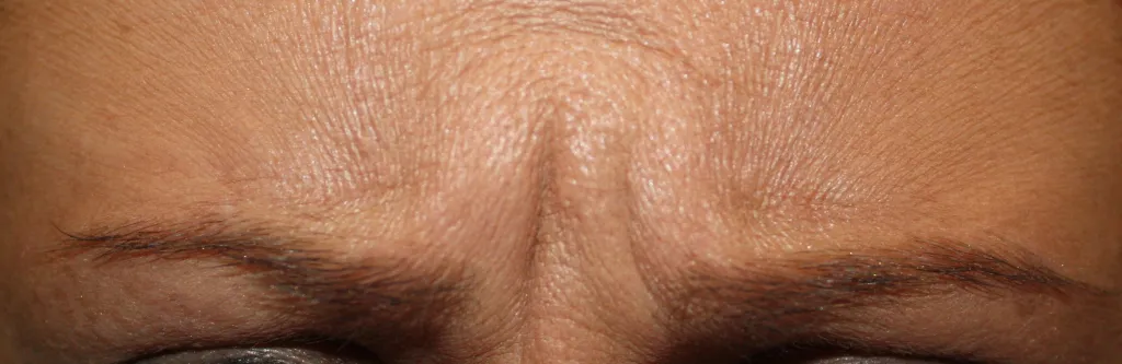 Patient's brow before Botox