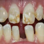 Patient's teeth before veneers and a bridge