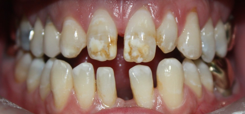 Patient's teeth before veneers and a bridge