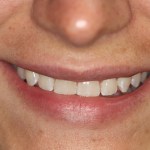 Patient's lips before Juvederm