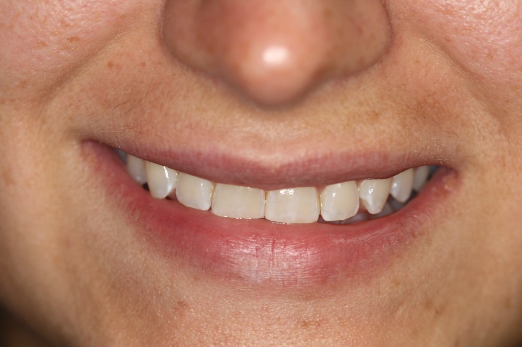 Patient's lips before Juvederm