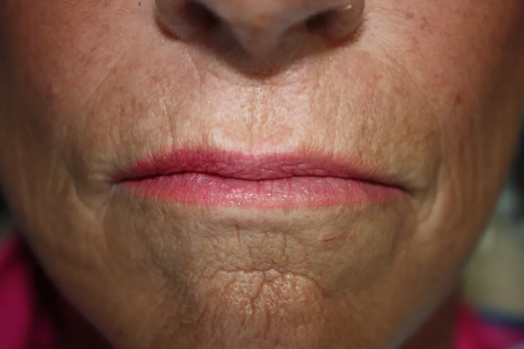 Patient's lips before Juvederm