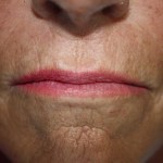 Patient's lips before Juvederm