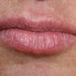 Patient's lips before Juvederm