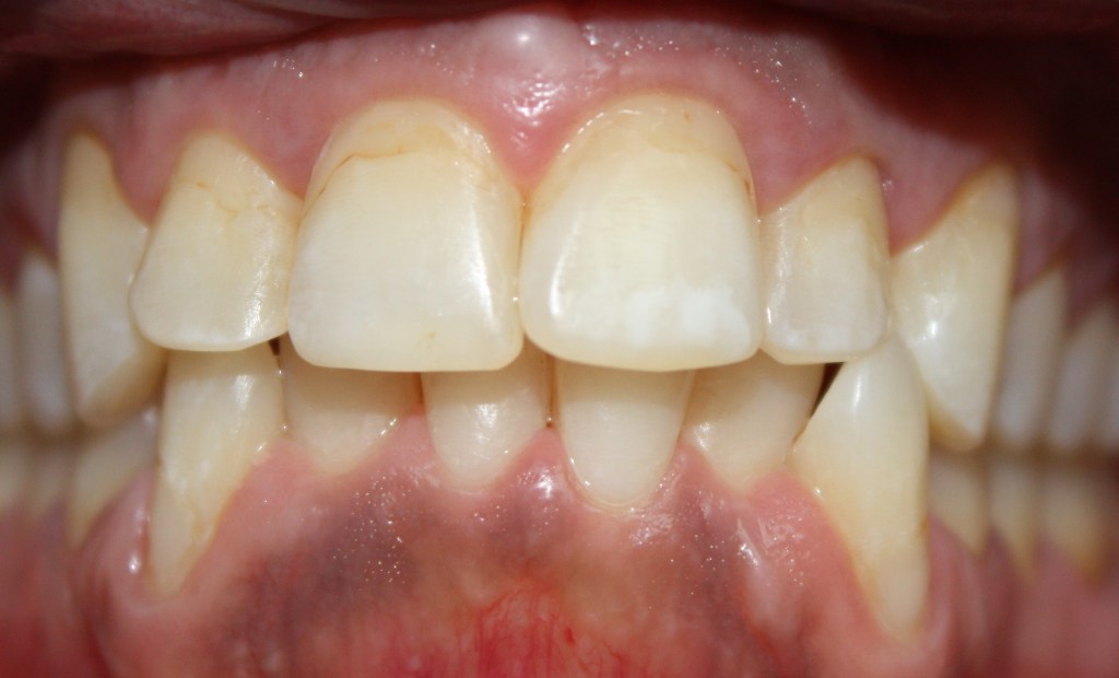 Patient's teeth before Veneers