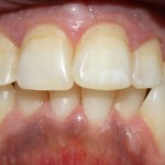 Patient's teeth before Veneers