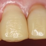 Patient's teeth before Veneers