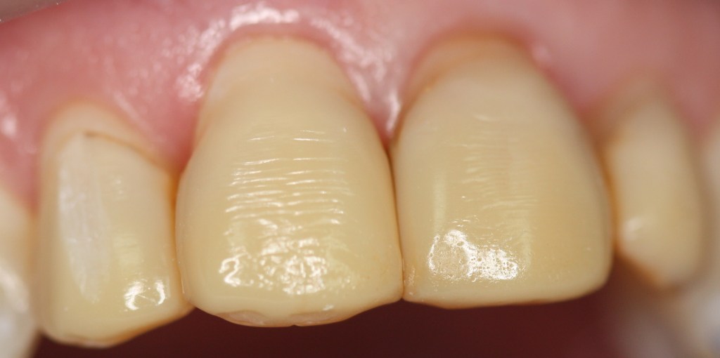 Patient's teeth before Veneers