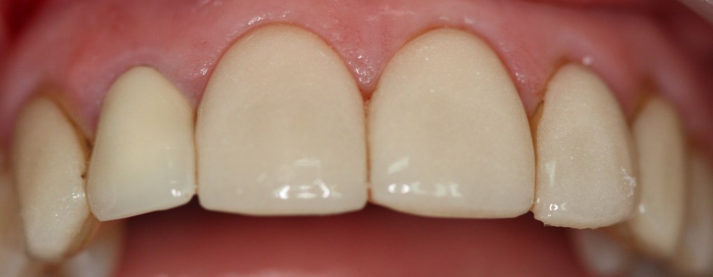 Patient's teeth before Veneers