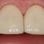 Patient's teeth before Veneers